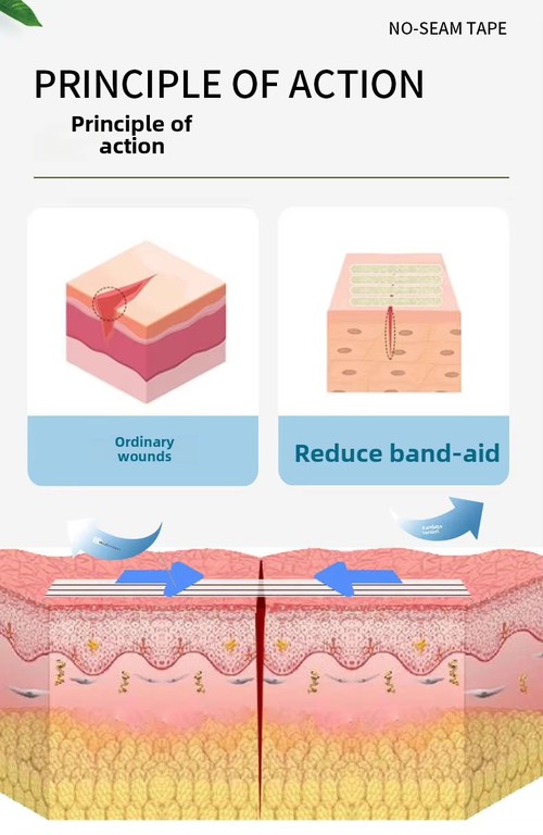 Adhesive wound closure strips Adhesive wound closure strips